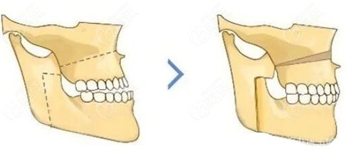 骨性反颌要做正颌手术