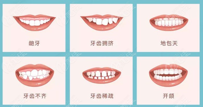 来看看牙齿矫正适应症都有哪些