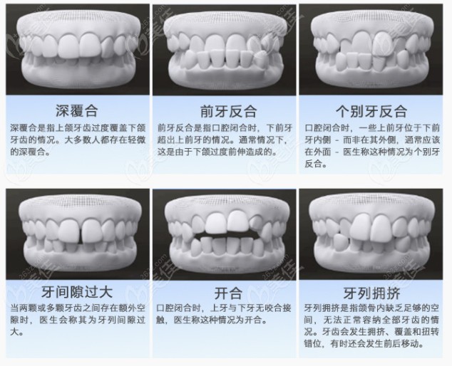 以下牙齿情况都是可以通过矫正牙齿改善的哦