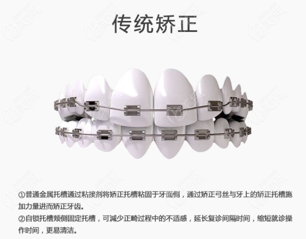 来看看什么是传统钢牙套吧