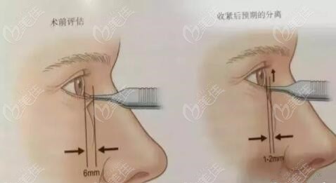 中面部提升术是怎么做的