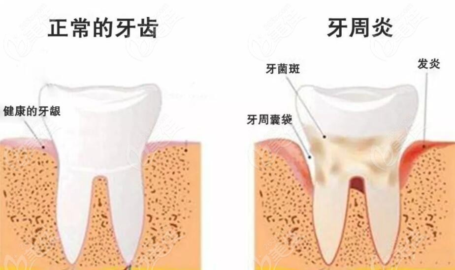 缺牙种植区牙周要健康