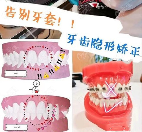 牙齿矫正器类型