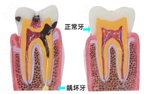 龋齿和正常牙对比图