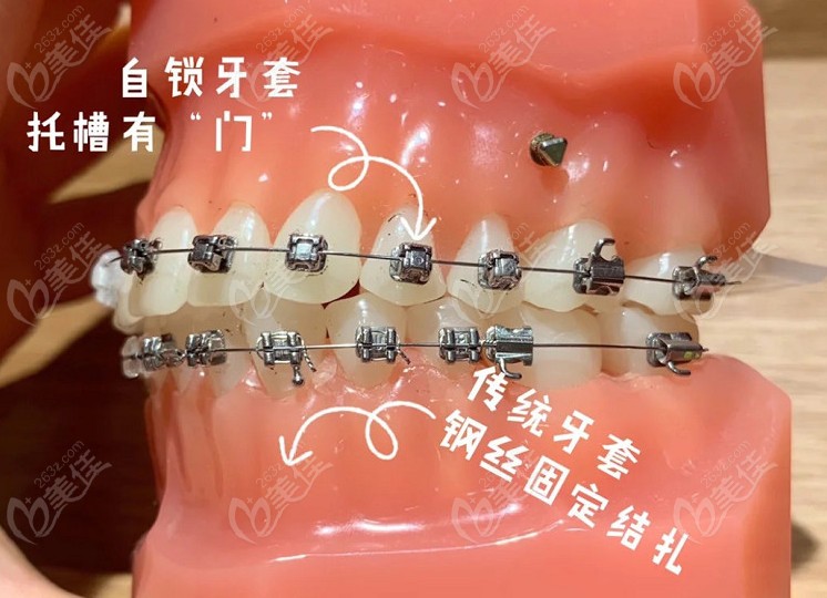 金属自锁牙套和传统金属牙套的区别
