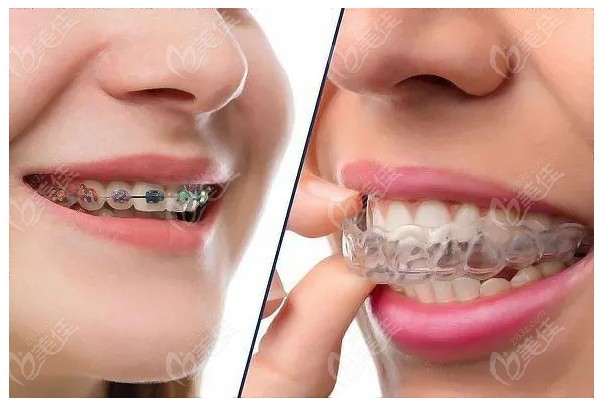 金属自锁矫正器和隐形牙套的区别