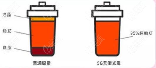 武汉韩辰5g天使光雕吸脂纯度