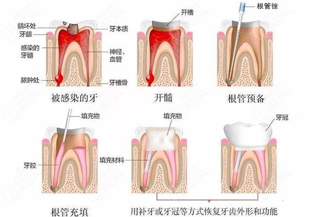 深圳平湖牙科根管治疗大概多少钱?平湖这几家牙科做的好价格还不贵