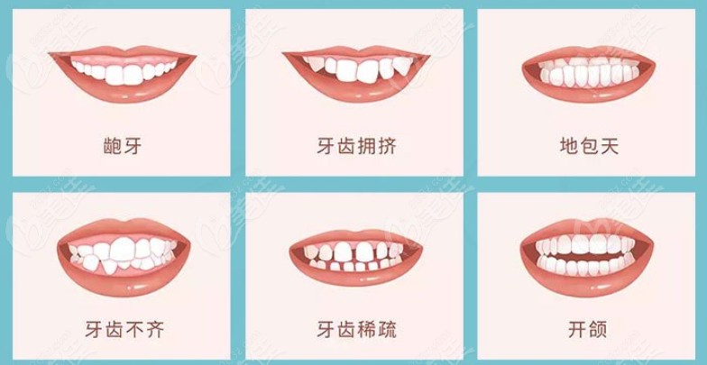 有以下牙齿情况的都可以通过隐形矫正进行改善