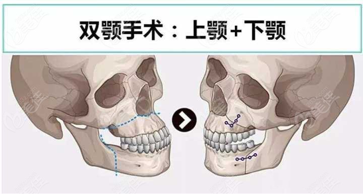 双鄂正颌手术的改善和术后固定方式