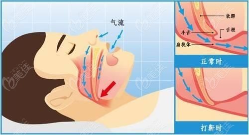 打呼噜的引起原因