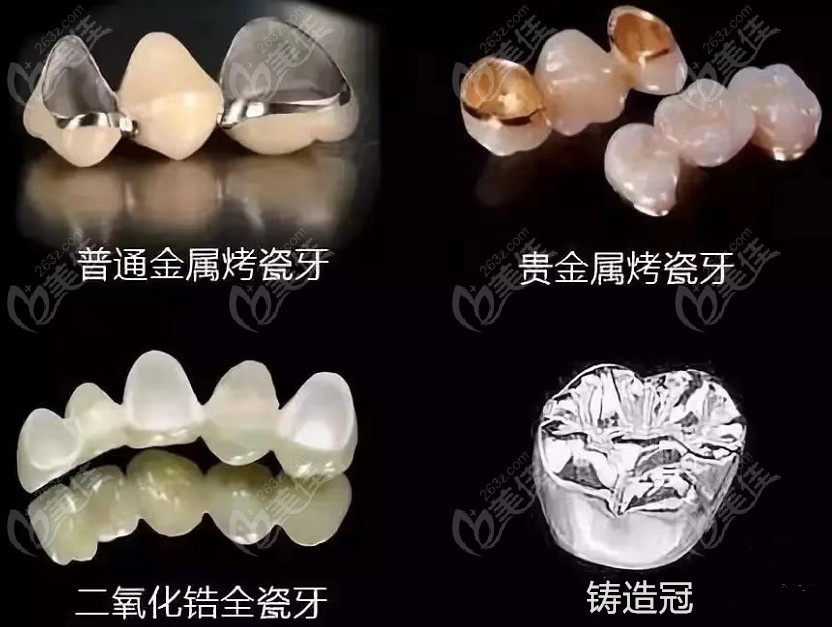 镶牙的材质种类了解下