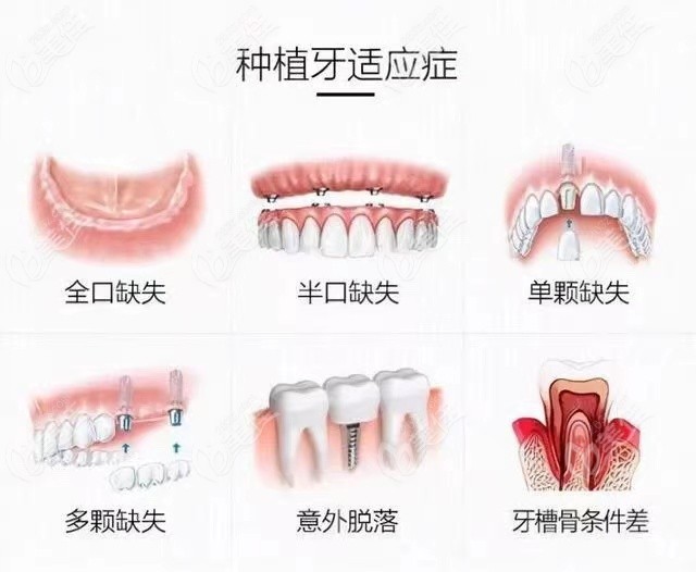 下图为种植牙的适应症