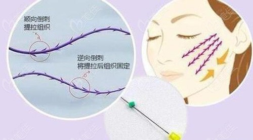 埋线提升原理