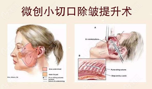 微创小切口除皱手术的原理
