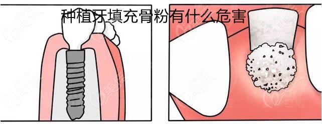 种植牙填充骨粉有什么危害