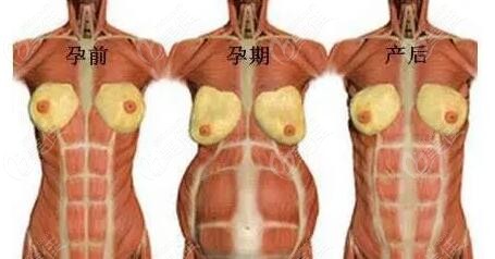 腹直肌分离的变化及原因