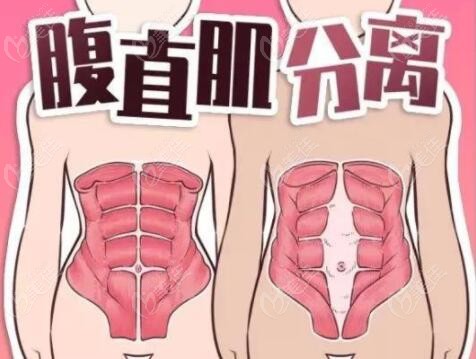 腹直肌分离做腹壁成型术