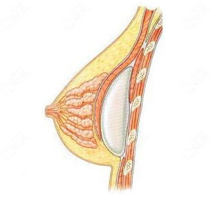 硅胶假体隆胸图图片