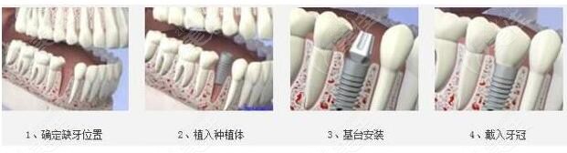 种植牙过程详细步骤