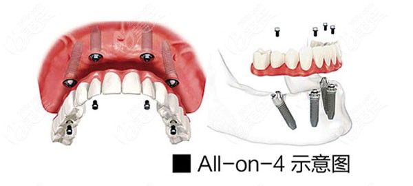 ALL-ON-4（6）种植牙