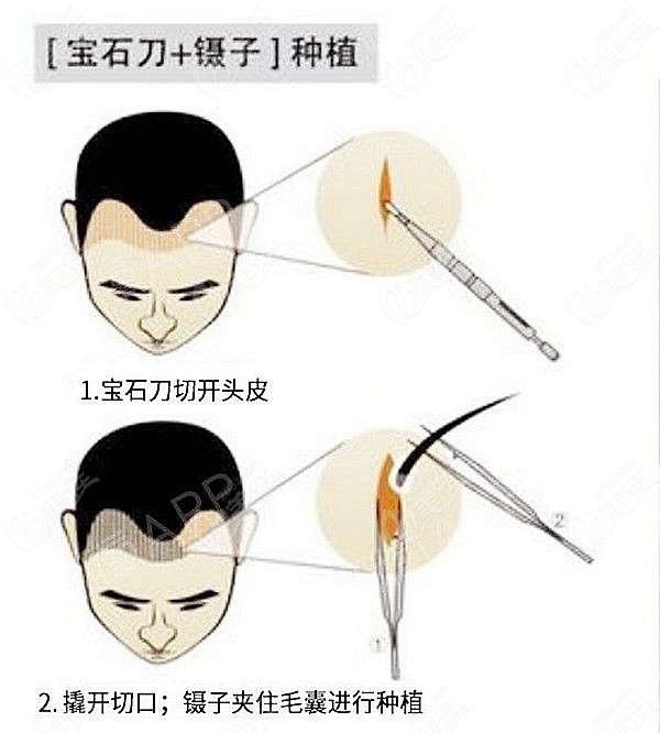 探索为啥宝石刀适合大面积种植及它和微针植发价格一样吗