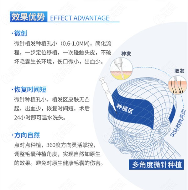 微针植发技术优势