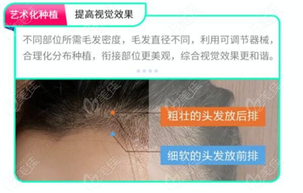 发际线下调，微针pse和ptt怎么选择