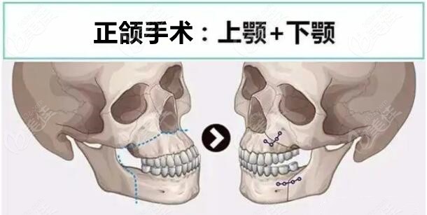 正颌手术操作图示