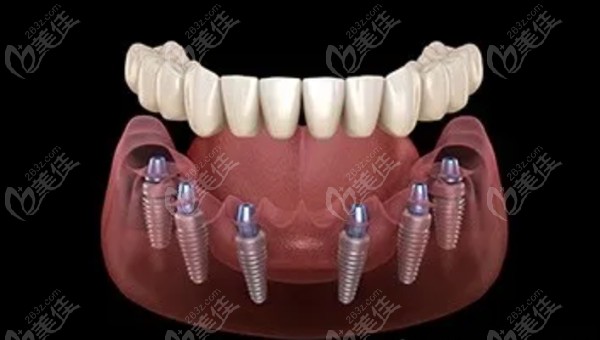 All-on-6种植牙的详细步骤示意图