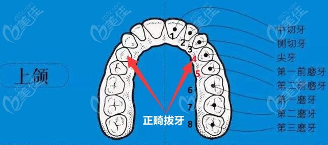 上颌正畸拔牙——4号牙或5号牙
