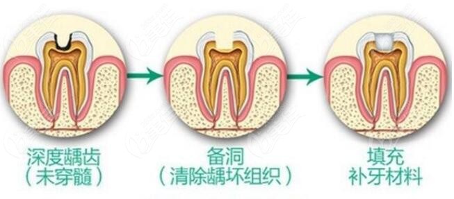 补牙的流程图