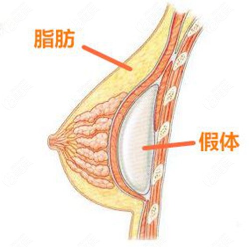 吉林華怡除了假體隆胸手術,還能做脂肪豐胸,以及複合隆胸手術.