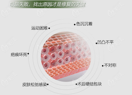 吸脂失敗如何修復(fù) 吸脂失敗如何修復(fù)