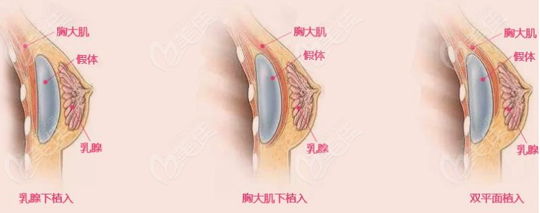 假体隆胸植入方式