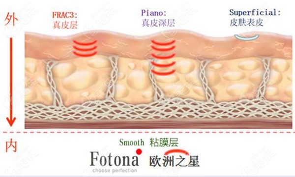 欧洲之星Fotona 4D pro作用部位