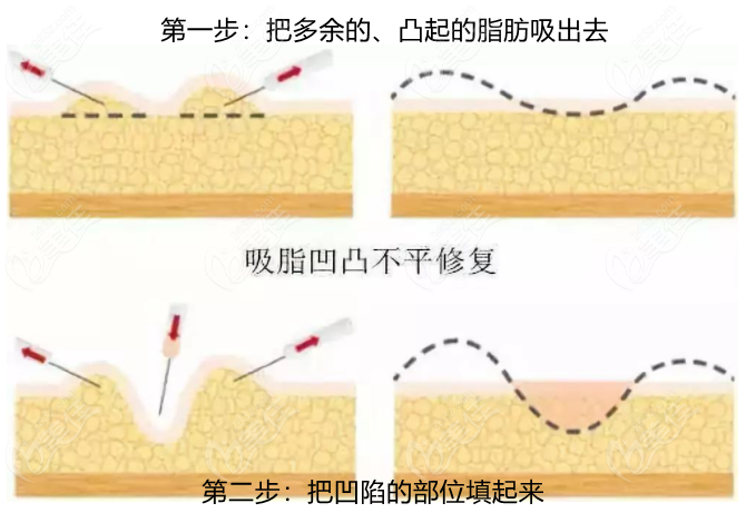 大腿吸脂后內(nèi)側(cè)局部凹凸不平怎么修復(fù) 大腿吸脂后內(nèi)側(cè)局部凹凸不平怎么修復(fù)