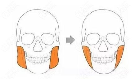 下颌角去咬肌手术后是否会影响咀嚼功能