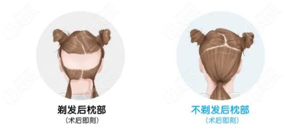 不剃发植发技术植发一个毛囊单位大概40-60元左右。