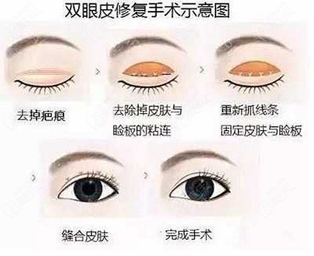 二次双眼皮修复手术过程