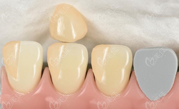 全瓷冠崩瓷后是否可以補瓷