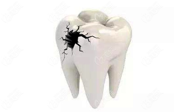 牙齿坏掉需要做根管治疗