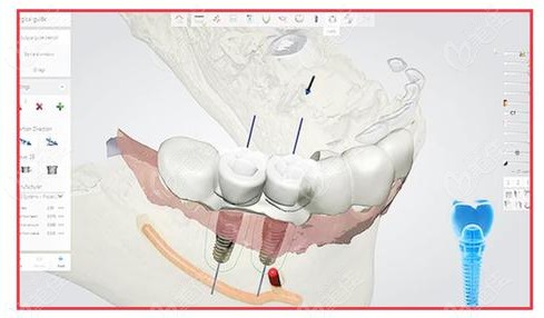 长沙美莱口腔的3D导板种植技术