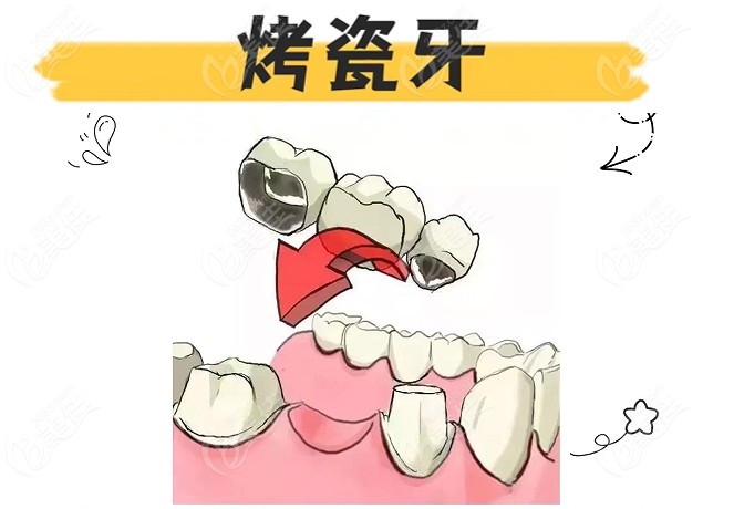 来看看烤瓷牙是如何对缺失牙齿进行修复的吧