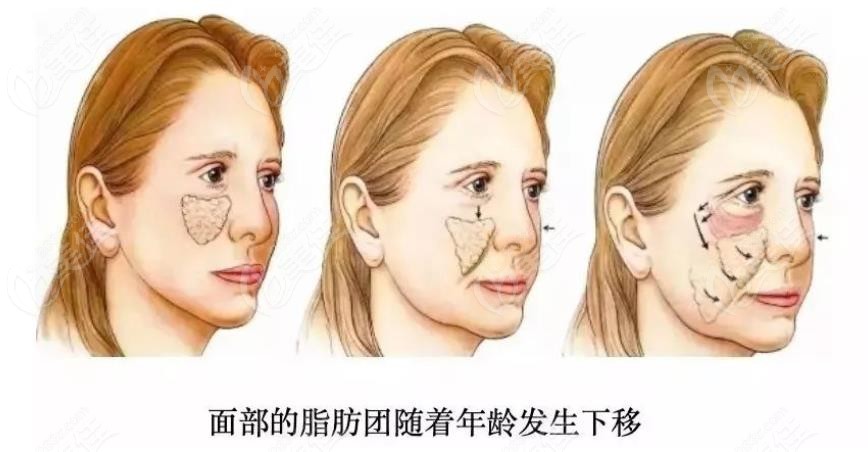 苹果肌复位做青春支架成效好
