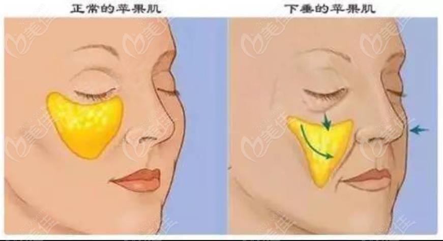 苹果肌复位做自体脂肪填充成效不太好