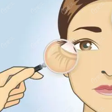 做眼部音波提拉的费用要根据眼纹的实际情况等来收费
