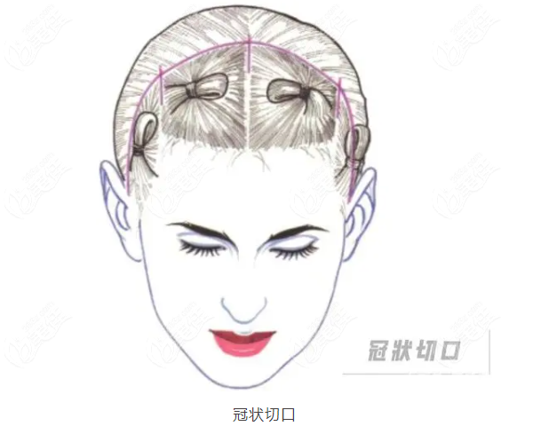面部大拉皮手术的切口在什么位置
