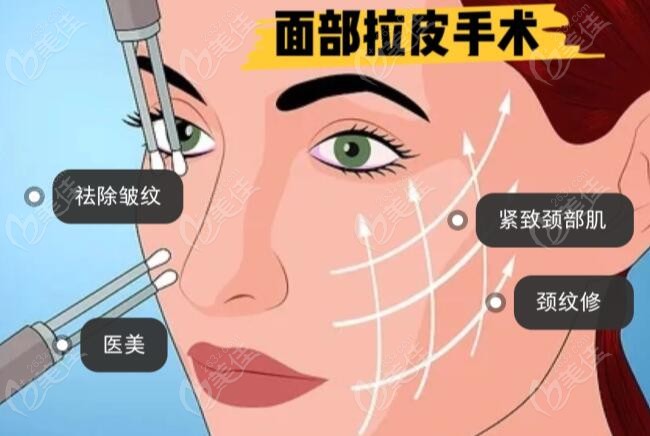 面部拉皮手术