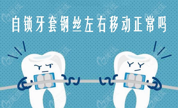 自锁牙套钢丝左右移动正常吗